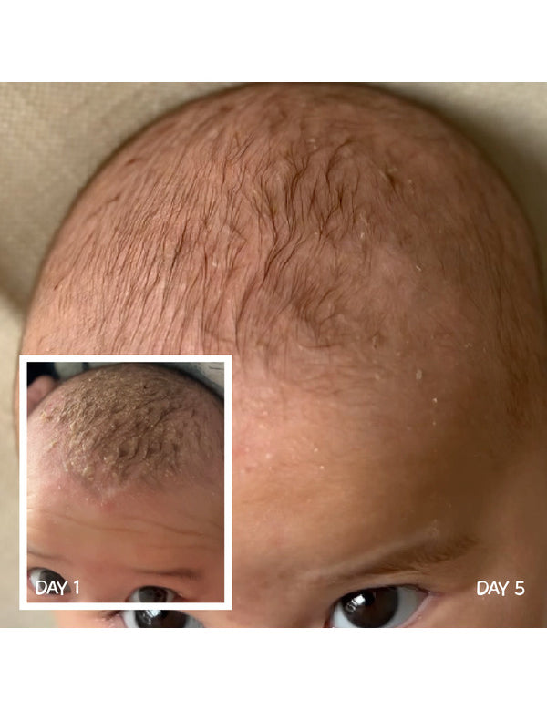 Close-up of a baby's scalp labelled Day 5, with a Day 1 inset showing thicker yellowish crusts along the front of the scalp.