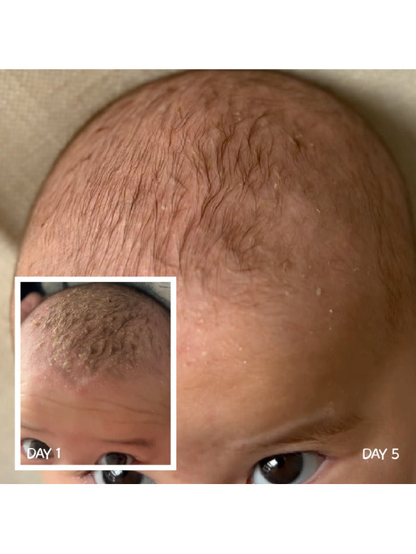 Close-up of a baby's scalp labelled Day 5, with a Day 1 inset showing thicker yellowish crusts along the front of the scalp.