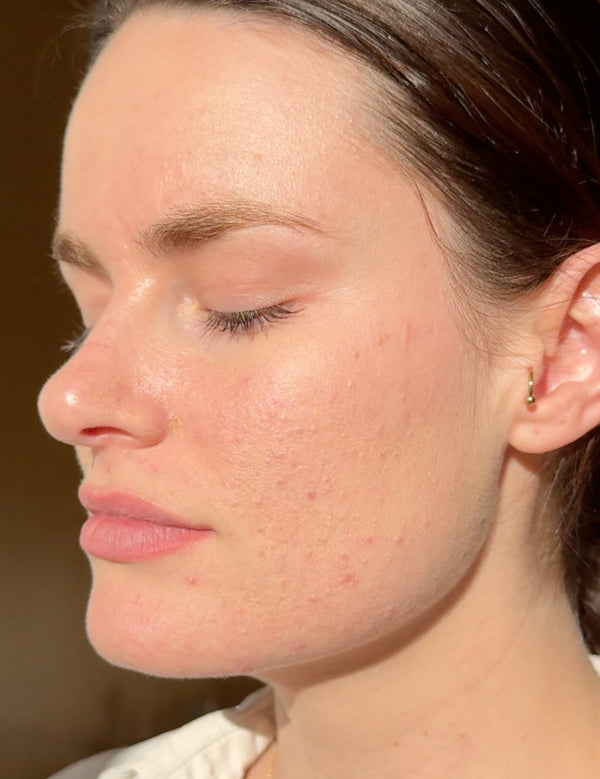 Close-up profile of a woman with calm hydrated skin after applying Mukti Barrier Repair Serum.
