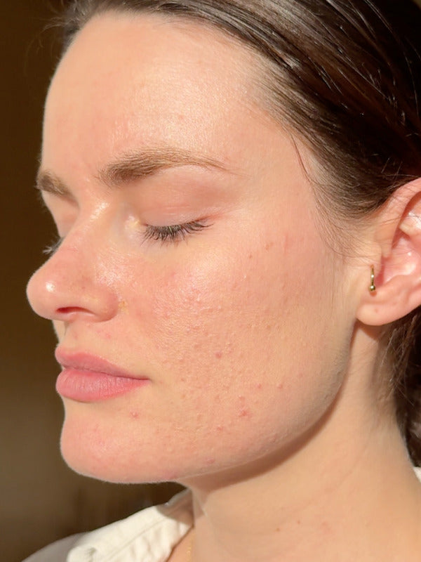 Close-up profile of a woman with calm hydrated skin after applying Mukti Barrier Repair Serum.