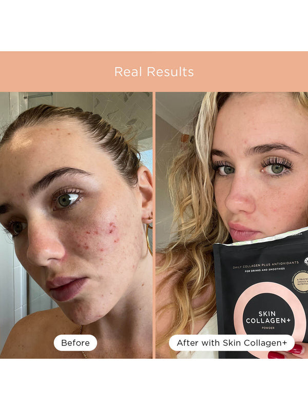 Before and after skin comparison using Tropeaka Skin Collagen