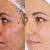 Side-by-side comparison of a woman’s face before and after using Vanessa Megan The Holy Trinity Daily Maintenance Full Routine; redness, acne, and dark spots on the left, smoother, clearer skin on the right after this plant-based skincare routine.