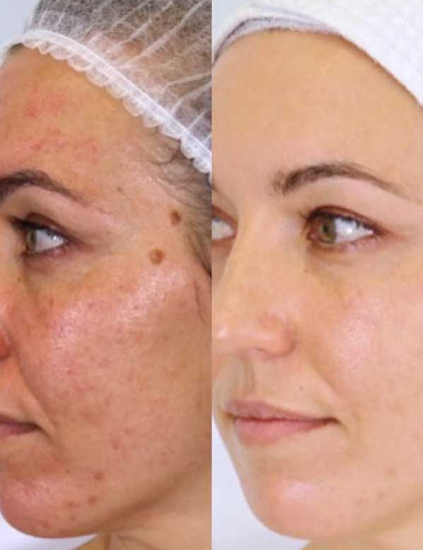 Side-by-side comparison of a woman’s face before and after using Vanessa Megan The Holy Trinity Daily Maintenance Full Routine; redness, acne, and dark spots on the left, smoother, clearer skin on the right after this plant-based skincare routine.