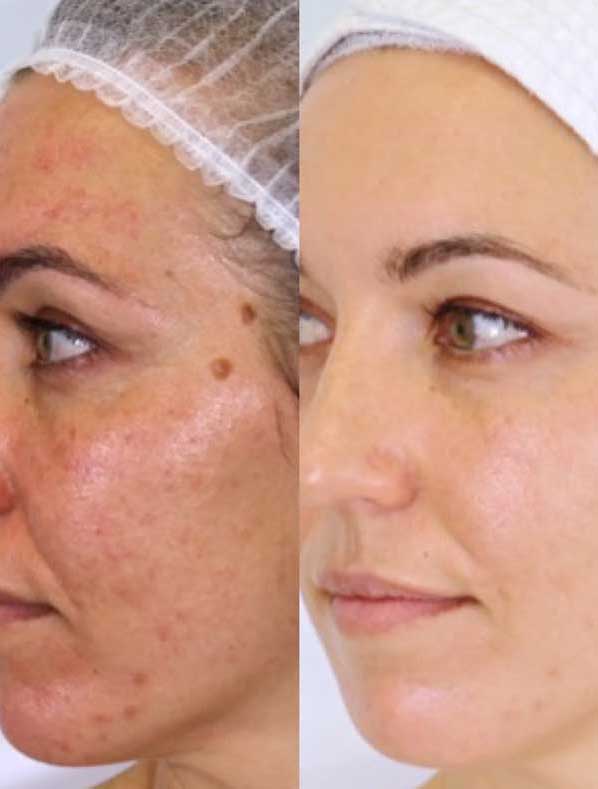 Side-by-side comparison of a woman’s face before and after using Vanessa Megan The Holy Trinity Daily Maintenance Full Routine; redness, acne, and dark spots on the left, smoother, clearer skin on the right after this plant-based skincare routine.