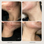 Before and after acne results after four months using Zilch Acne Formula – Zilch Acne Formula 180 Tablets