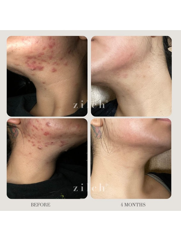 Before and after acne results after four months using Zilch Acne Formula – Zilch Acne Formula 180 Tablets