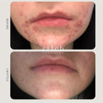 Before and after acne results after one bottle of Zilch Acne Formula – Zilch Acne Formula 180 Tablets