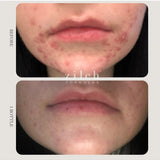 Before and after acne results after one bottle of Zilch Acne Formula – Zilch Acne Formula 180 Tablets