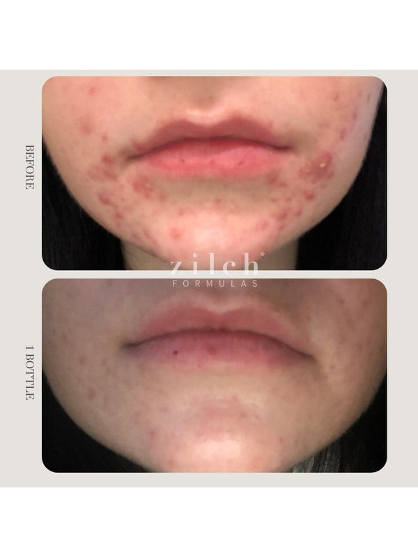 Before and after acne results after one bottle of Zilch Acne Formula – Zilch Acne Formula 180 Tablets