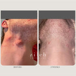 Before and after acne results after two weeks using Zilch Acne Formula – Zilch Acne Formula 180 Tablets
