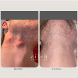 Before and after acne results after two weeks using Zilch Acne Formula – Zilch Acne Formula 180 Tablets