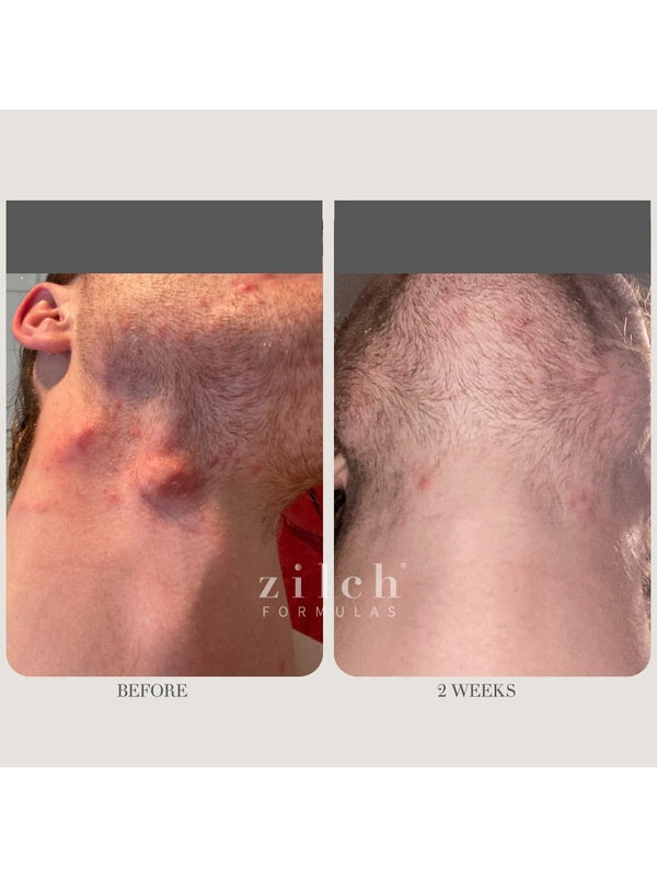 Before and after acne results after two weeks using Zilch Acne Formula – Zilch Acne Formula 180 Tablets