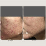 Before and after acne results after four weeks using Zilch Acne Formula – Zilch Acne Formula 180 Tablets