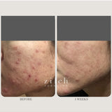 Before and after acne results after four weeks using Zilch Acne Formula – Zilch Acne Formula 180 Tablets