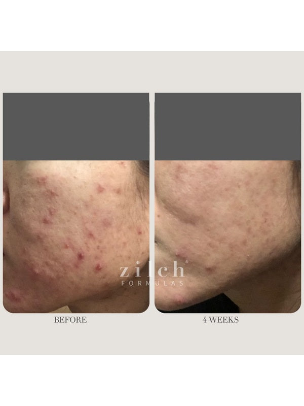 Before and after acne results after four weeks using Zilch Acne Formula – Zilch Acne Formula 180 Tablets